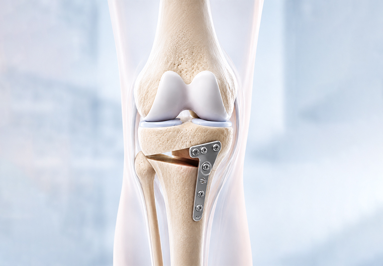 Yüksek Tibial Osteotomi ve Distal Femoral Osteotomi